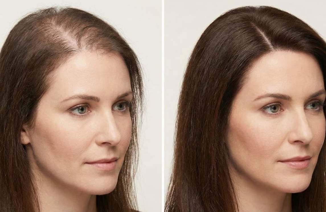 Tecnología Capilar y Fotobiomodulación