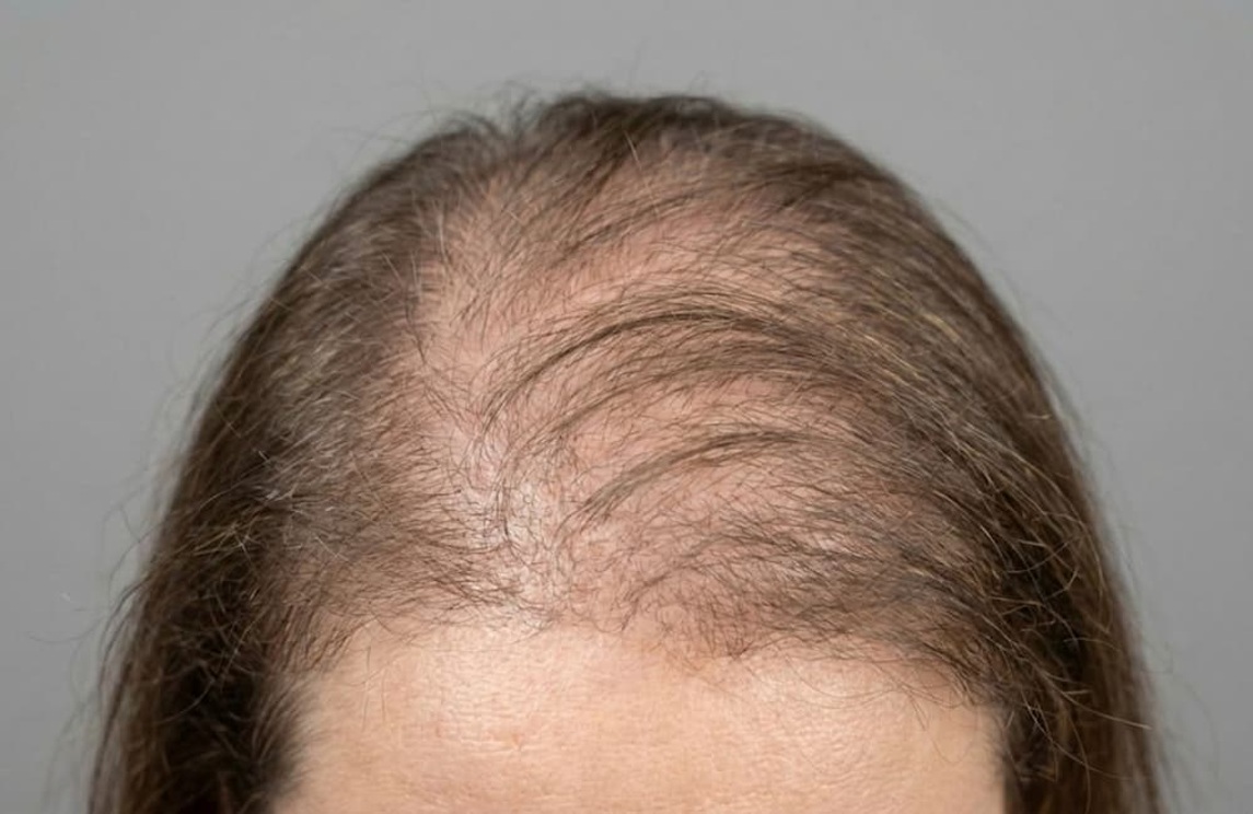 Pelo fino y falta de densidad