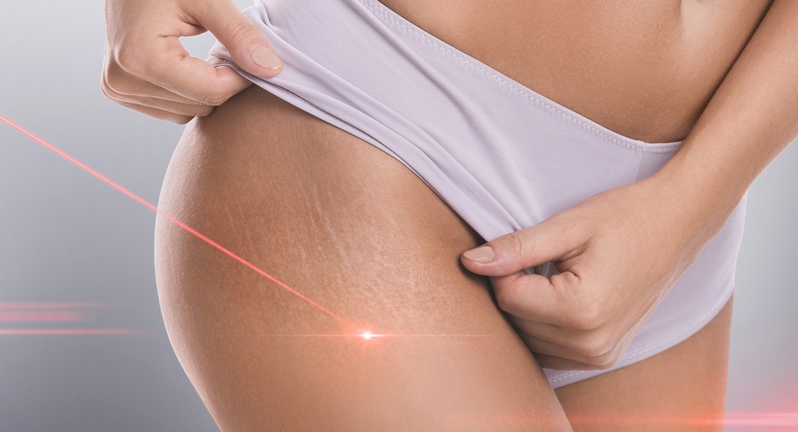 Laser: estrías, flacidez, varices