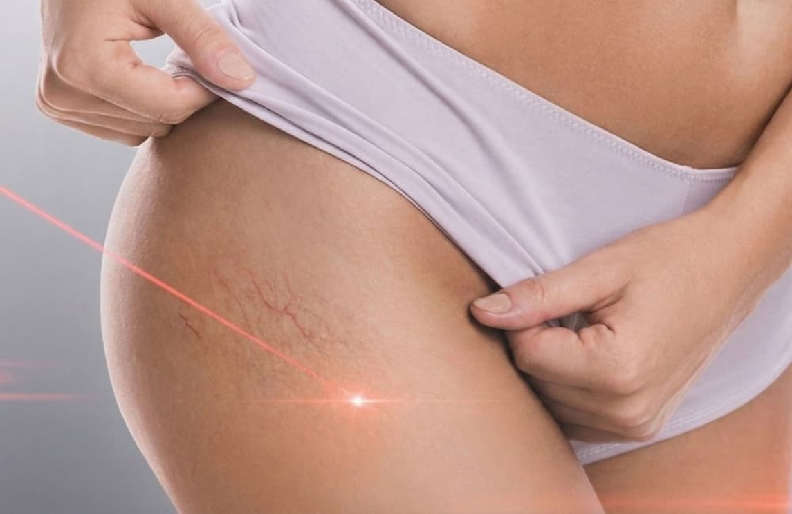 Salud vascular y celulitis