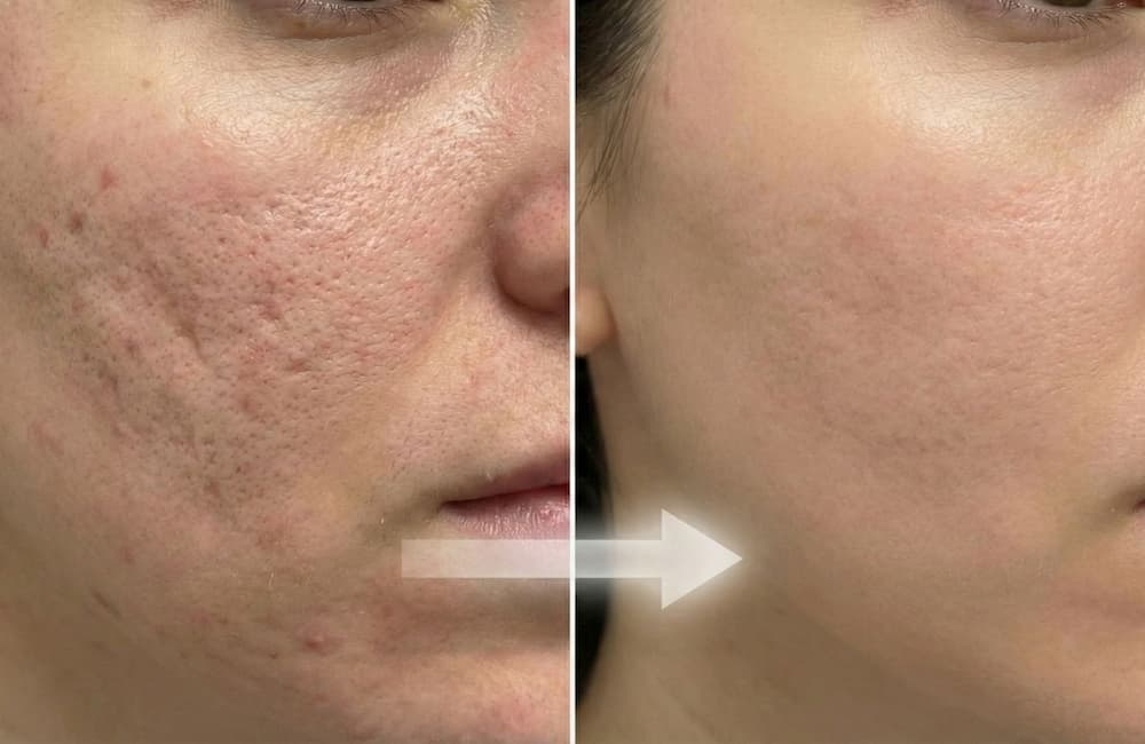 Cicatrices, acné e imperfecciones