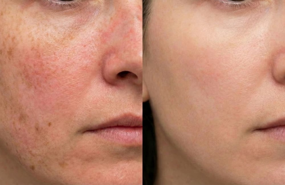 Manchas y daño solar